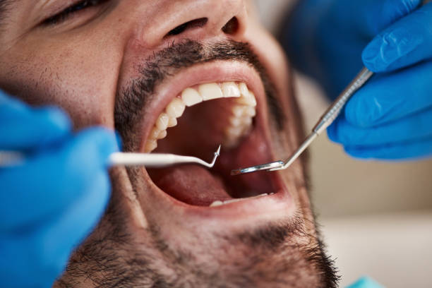 Best Knocked-Out Tooth (Avulsed Tooth) Treatment in Hugoton, KS